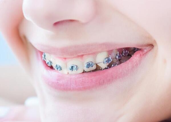 戴了牙套可以用電動牙刷嗎？戴牙套的人群必看！