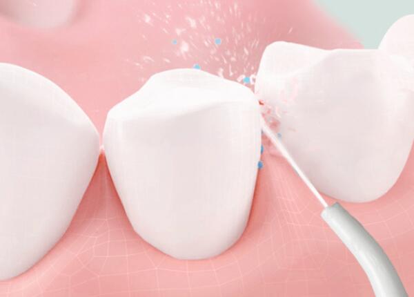 洗牙后用洗牙器好還是電動(dòng)牙刷？口腔清潔工具這樣選！