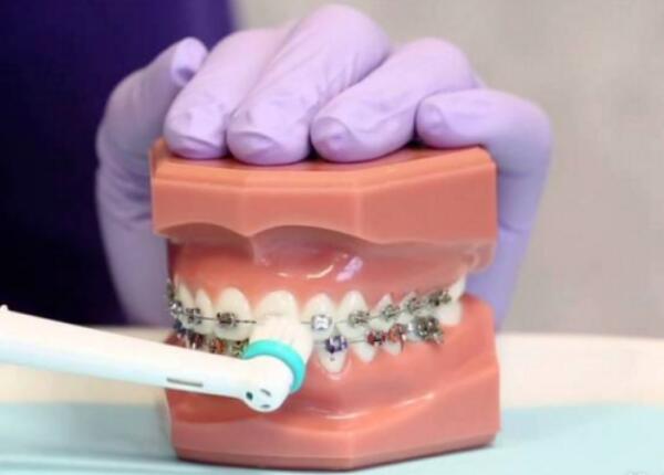 卸了牙套能用電動(dòng)牙刷嗎？答案就在這篇文章